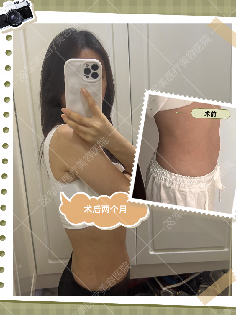 腰腹吸脂案例