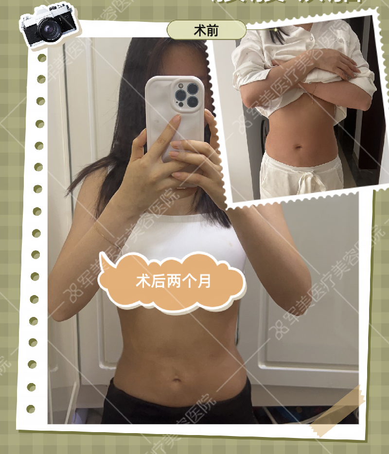 腰腹吸脂案例
