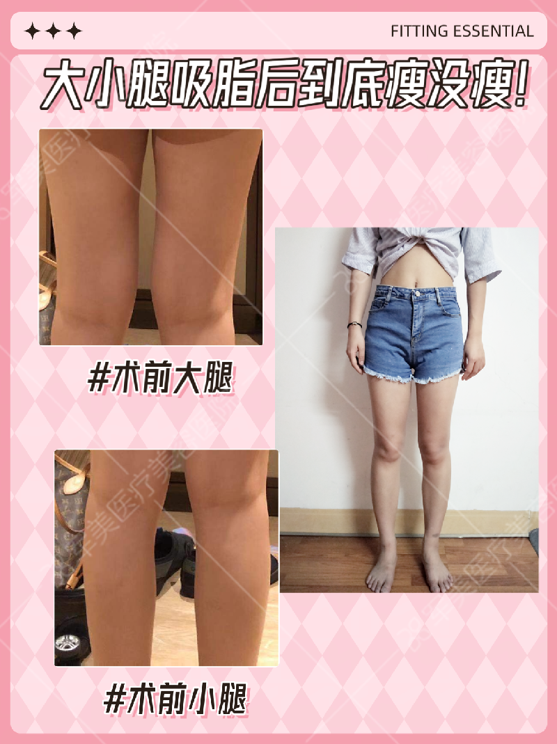 大腿吸脂前后效果图片