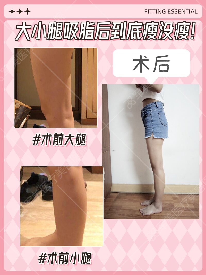大腿吸脂前后效果图片