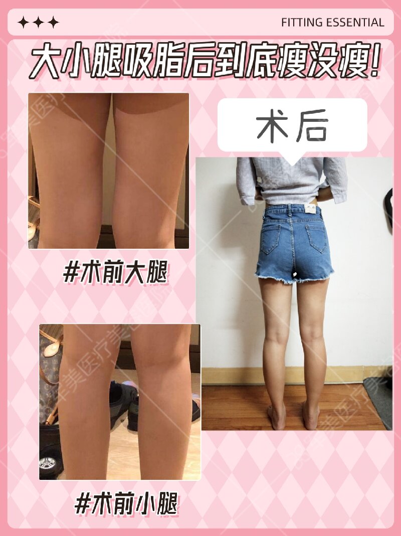 大腿吸脂前后效果图片