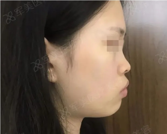 垫鼻基底前后对比照