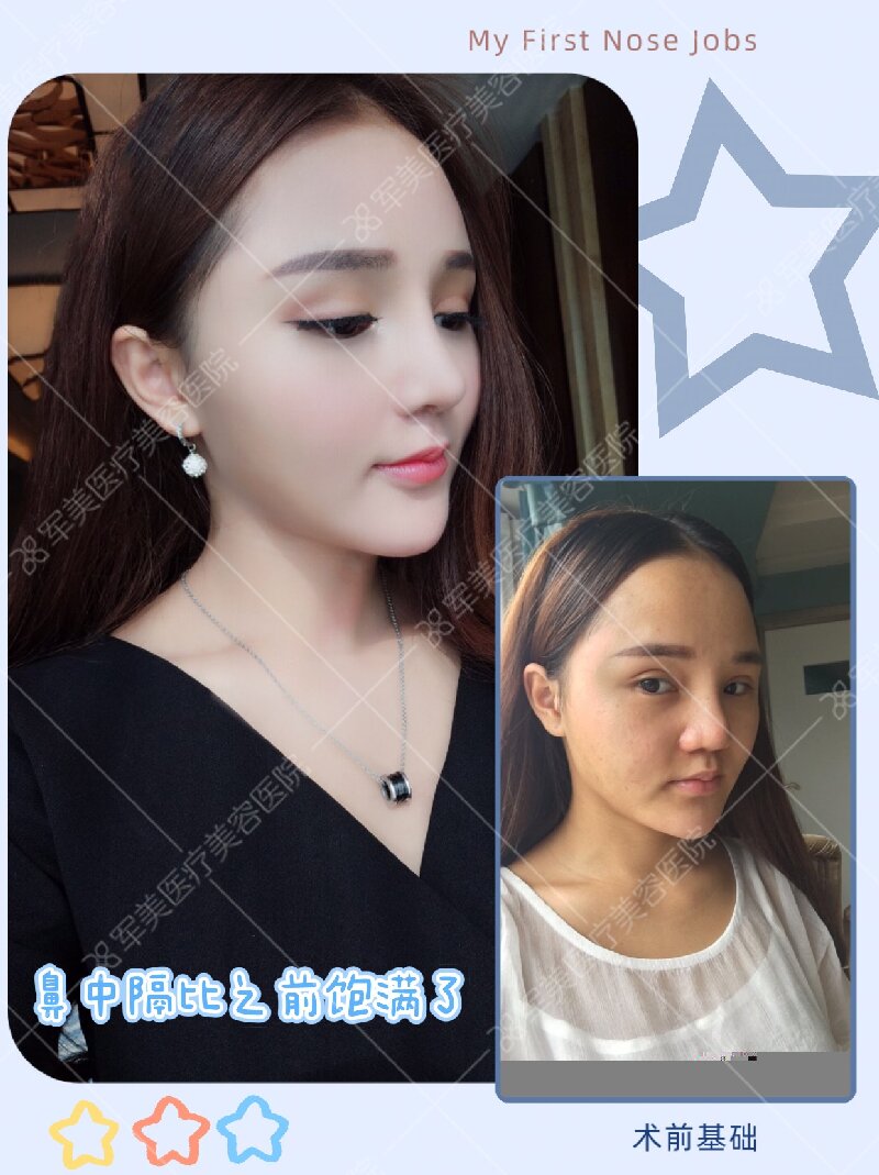 隆鼻前后对比图