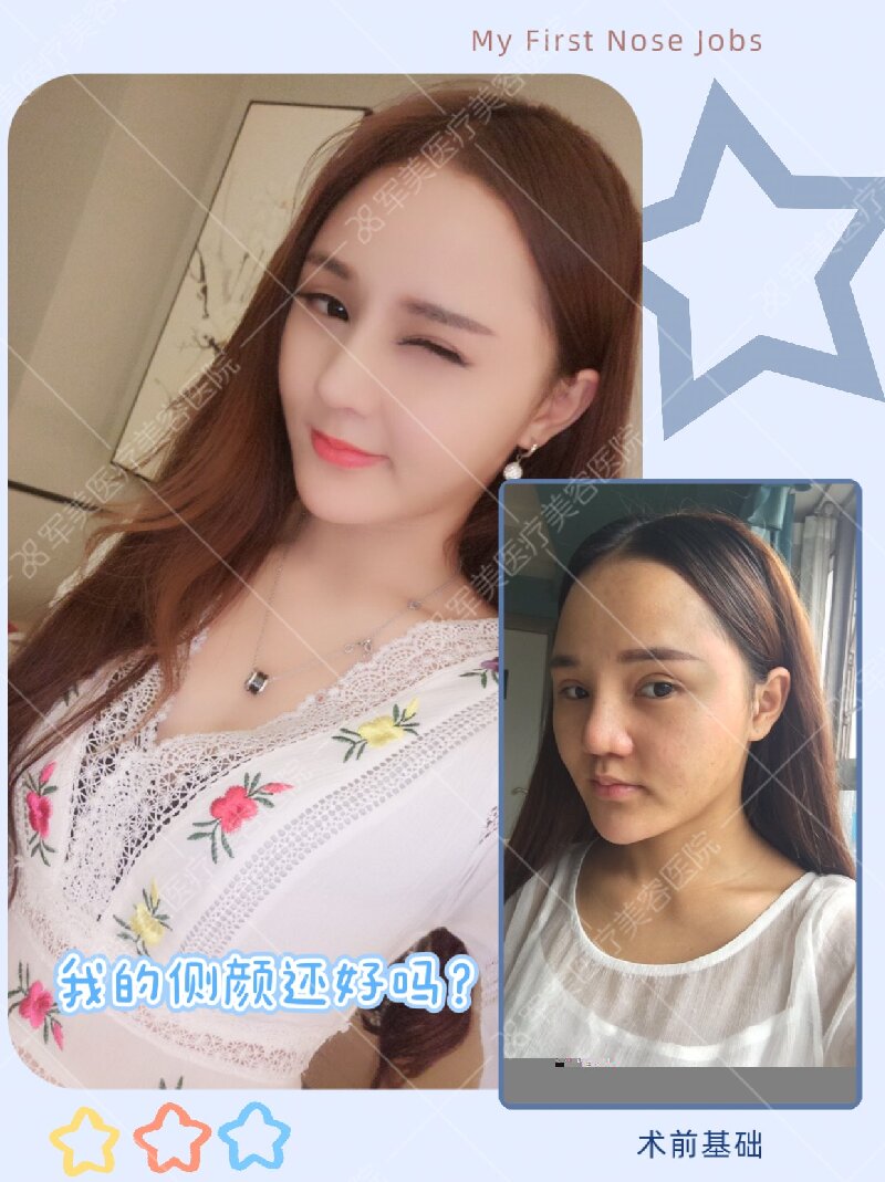 隆鼻前后对比图