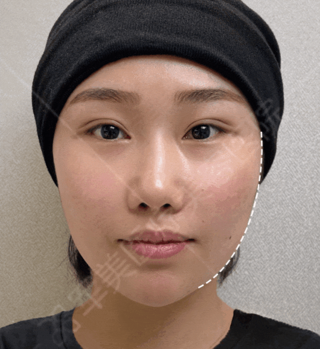 自体脂肪填充面部野生案例