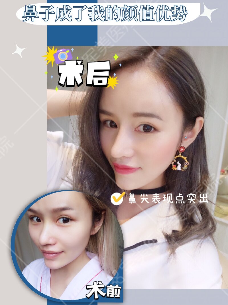 广州隆鼻医院哪家好