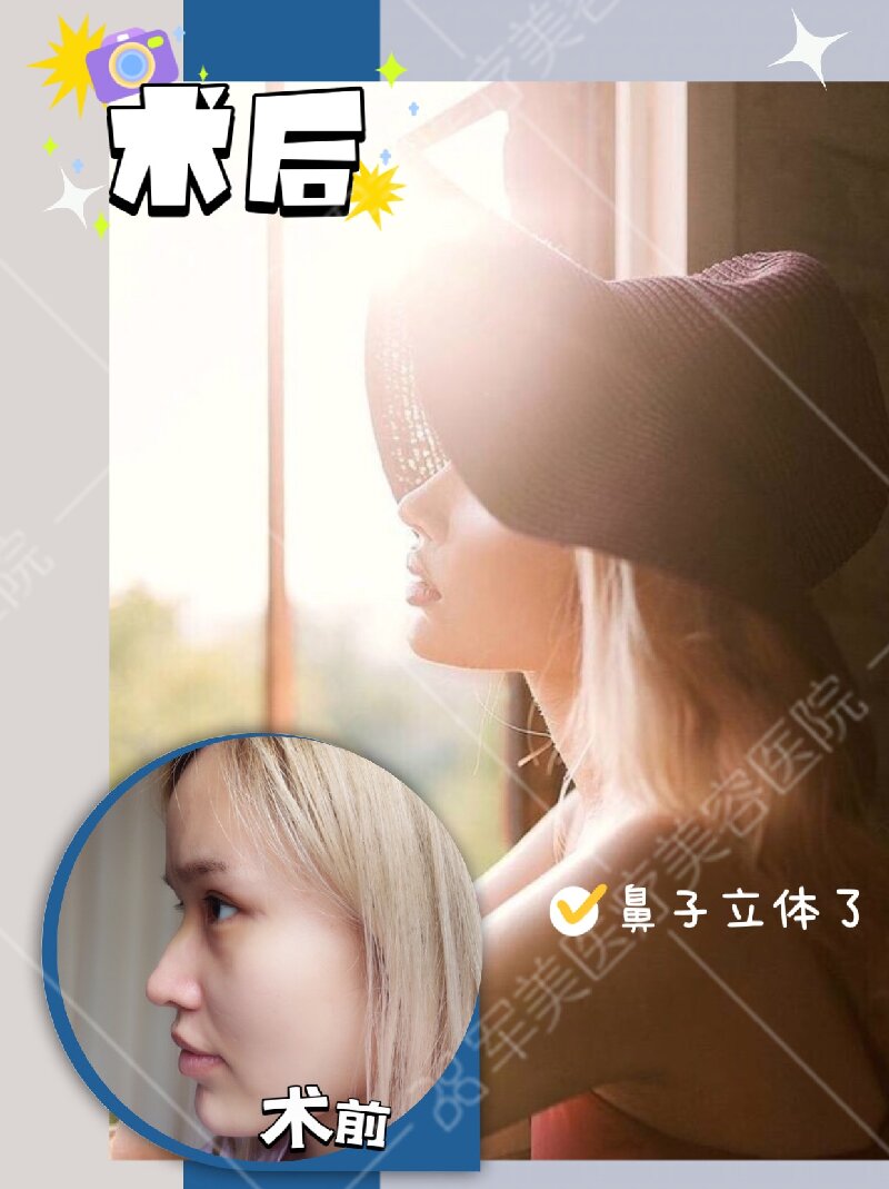 隆鼻野生案例