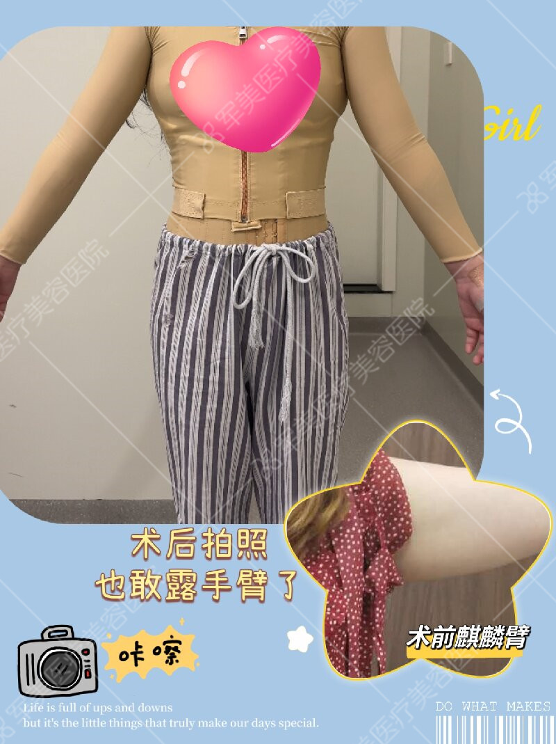 手臂吸脂野生案例