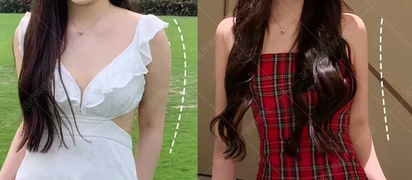 广州手臂抽脂哪里好