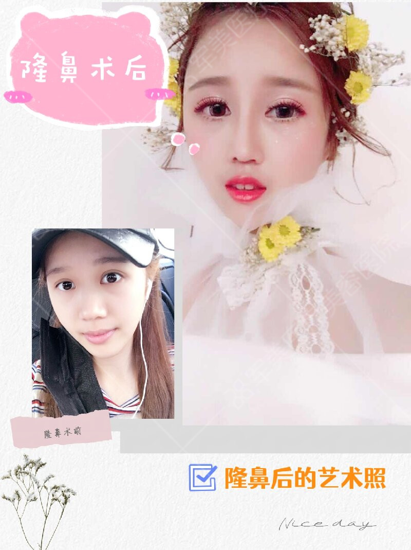 鼻头鼻翼肥大怎么缩小