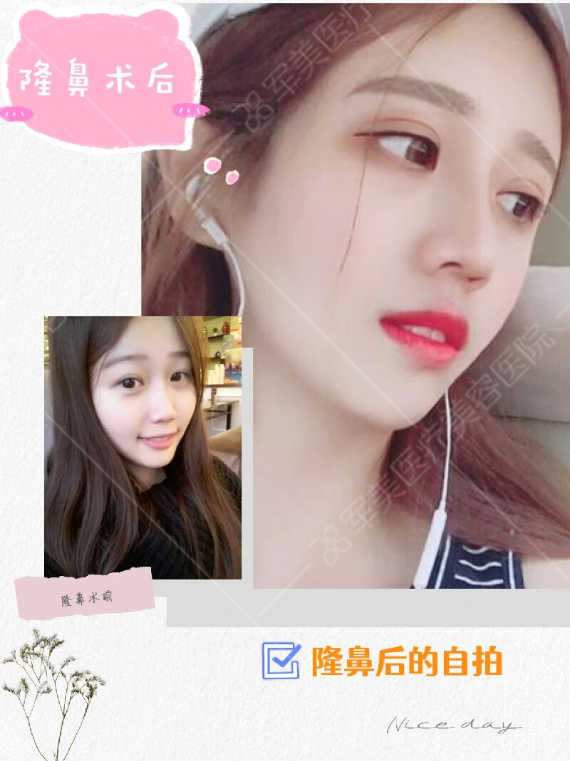 鼻子整形对比图