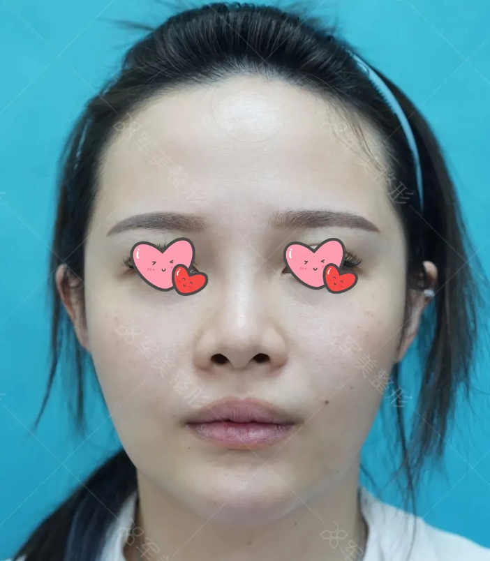 玻尿酸隆鼻好还是手术隆鼻好