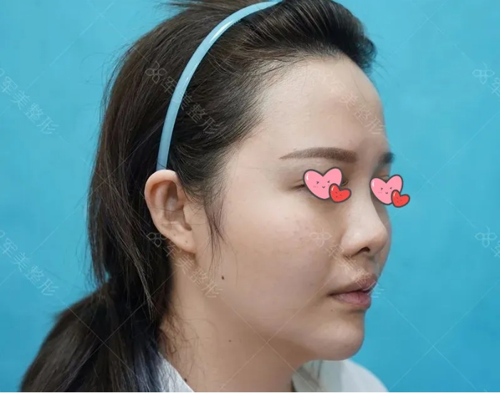玻尿酸隆鼻好还是手术隆鼻好