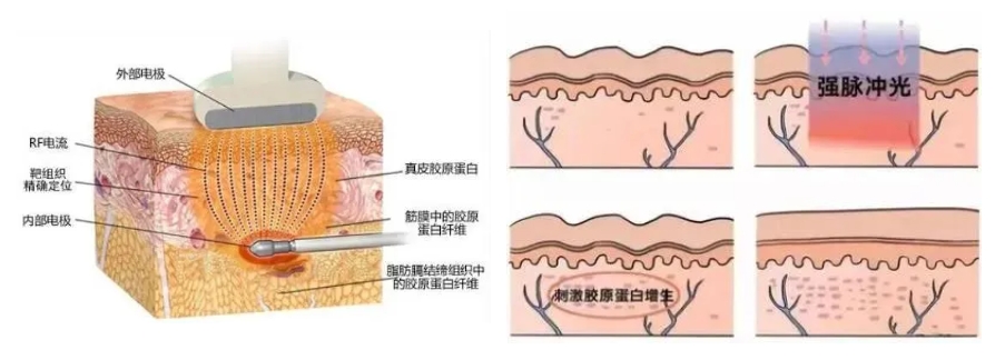 怎么去掉黑眼圈