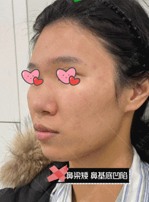 鼻基底填充真实案例分享