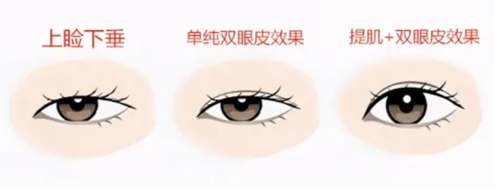割双眼皮哪个医院好