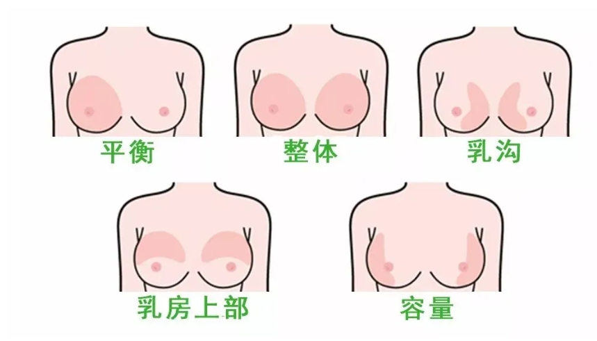 王世虎隆胸案例
