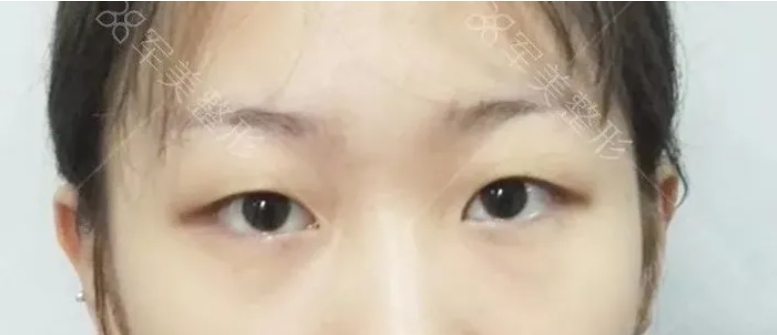 割双眼皮哪个医院好