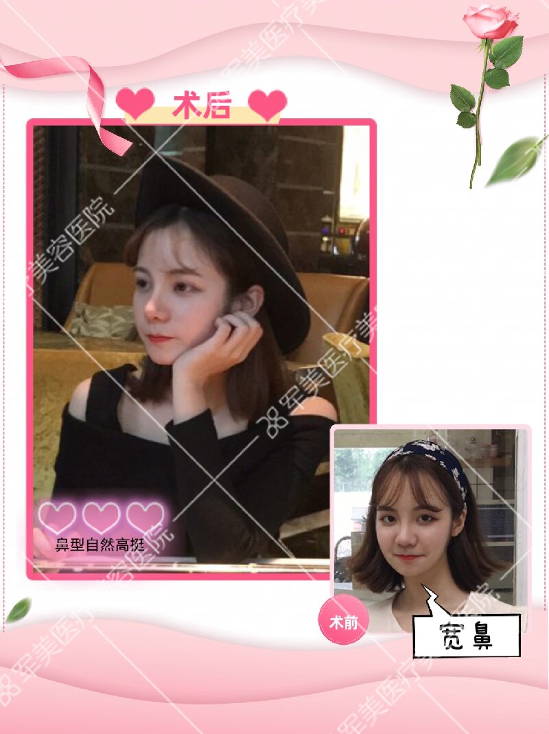 鼻整形整容哪个医院好