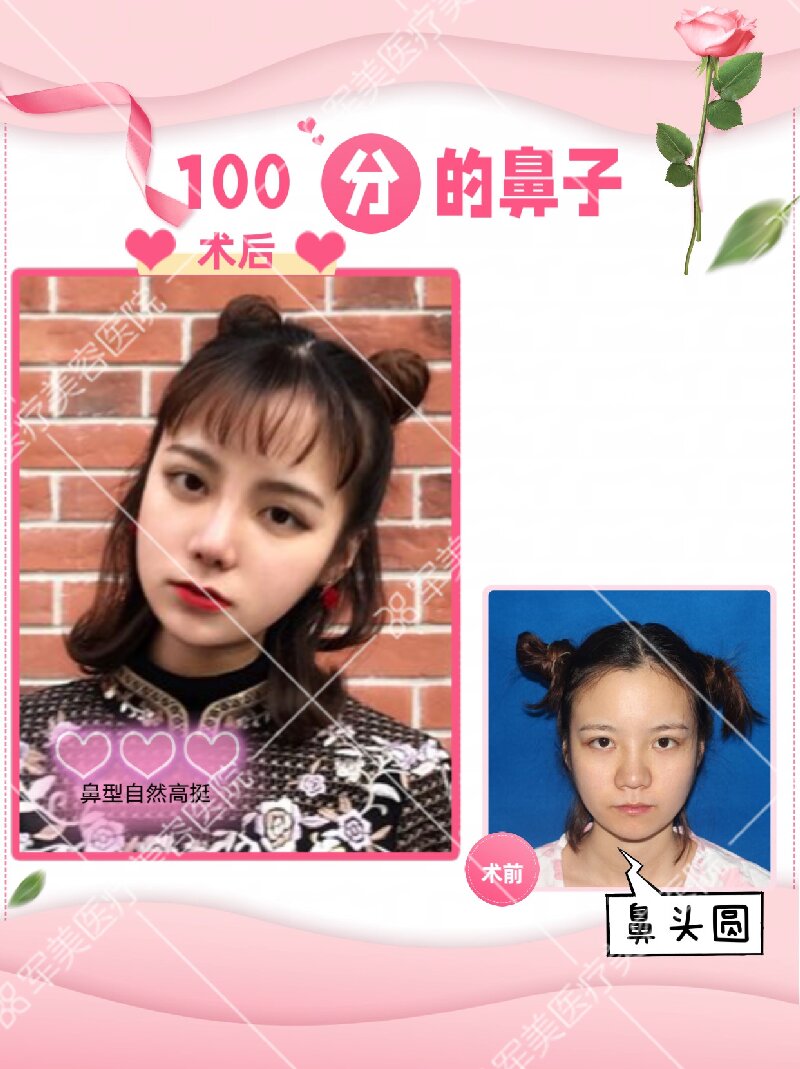 鼻整形整容哪个医院好