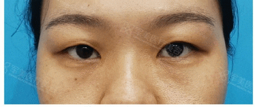 眼部整形案例