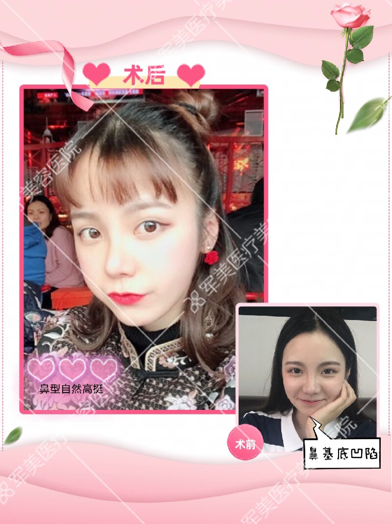 鼻整形整容哪个医院好