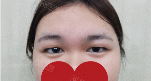 眼部整形案例