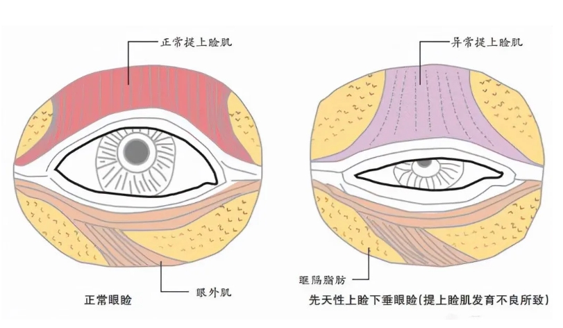 上睑下垂的原因