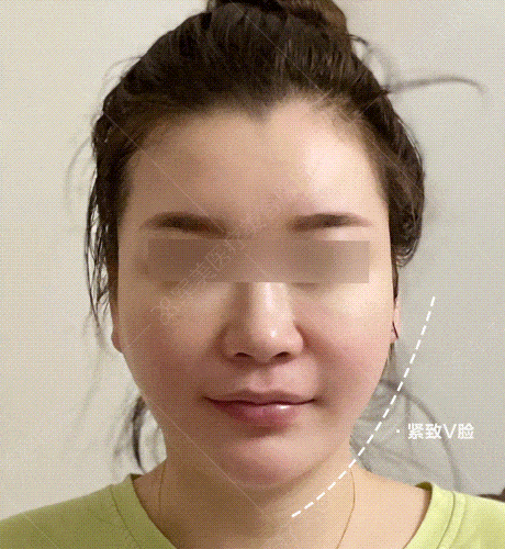 下颌线怎么收紧