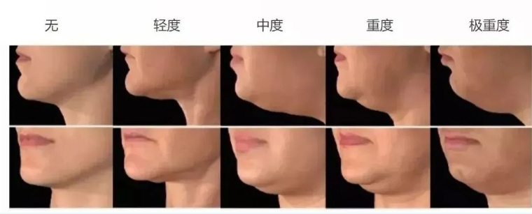 下颌线怎么收紧