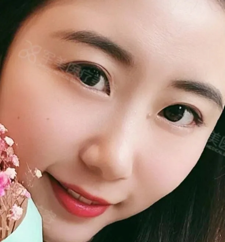 黑眼圈怎么改善