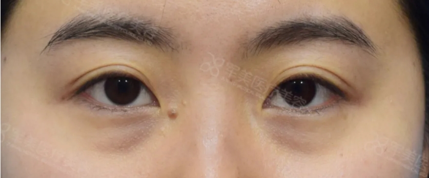 黑眼圈怎么改善