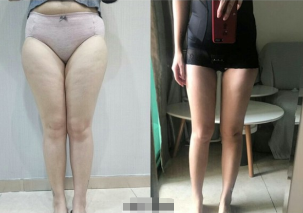 大腿吸脂案例