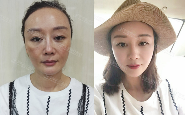 王世虎自体脂肪填充案例