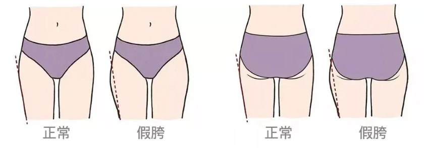 腿粗什么原因造成的