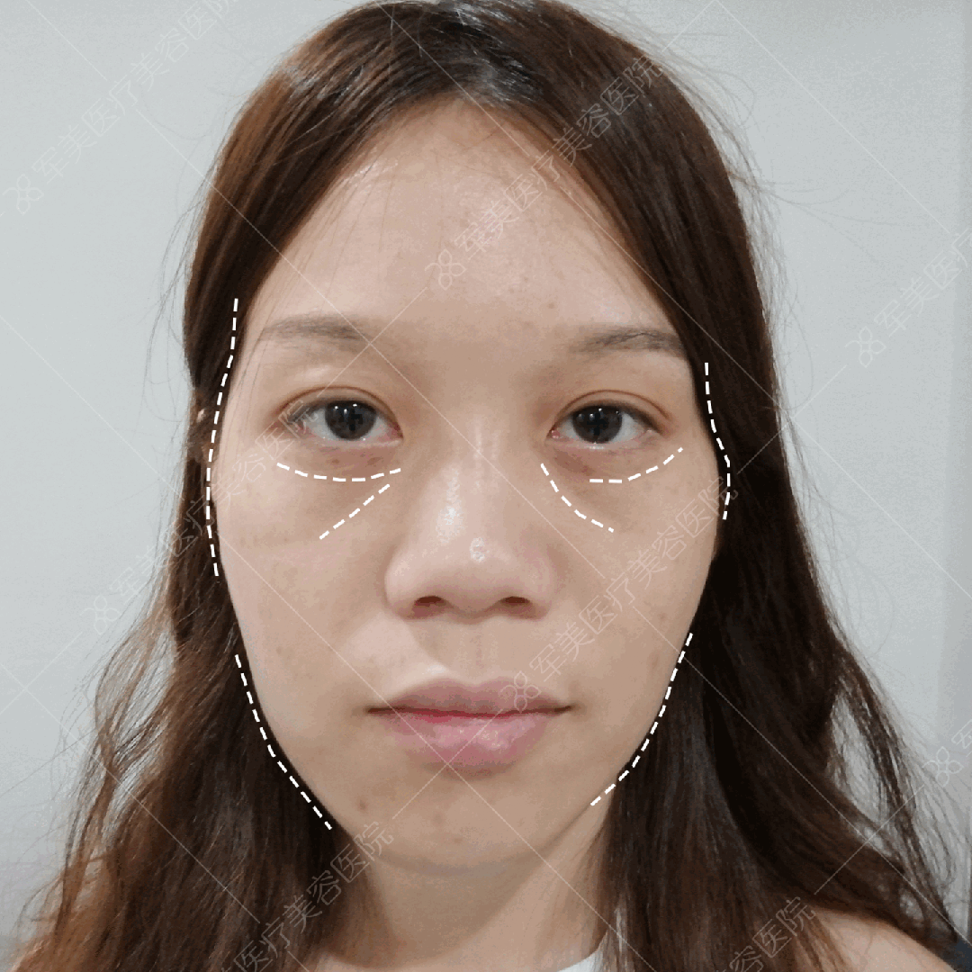王世虎自体脂肪填充面部案例