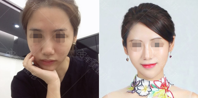 鼻综合前后对比照图片