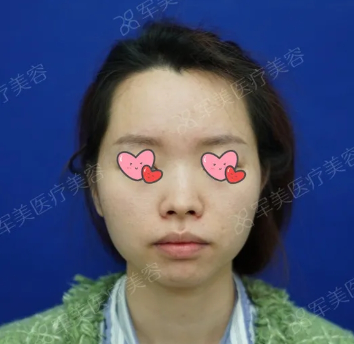 鼻综合前后对比照图片