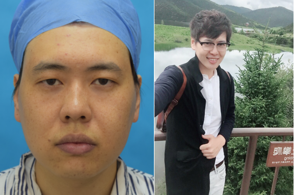 面部吸脂案例