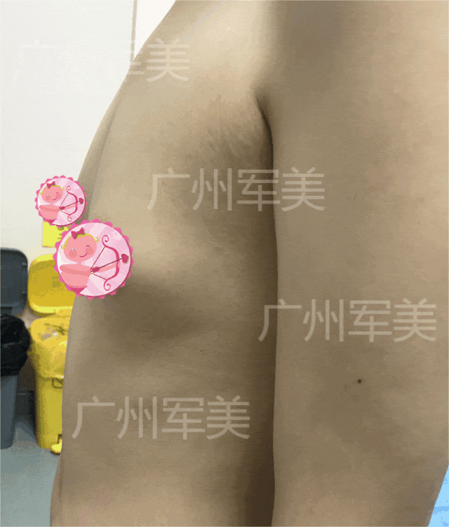 王世虎脂肪丰胸
