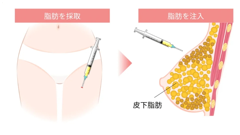 王世虎脂肪隆胸