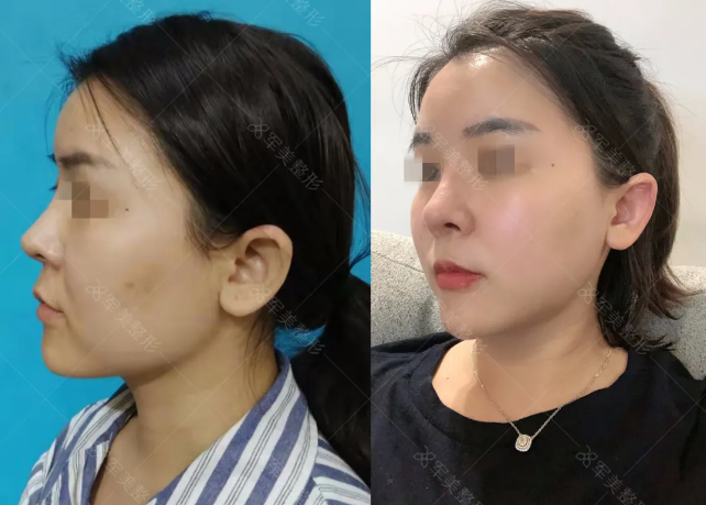 瘦脸针适合什么样的人打