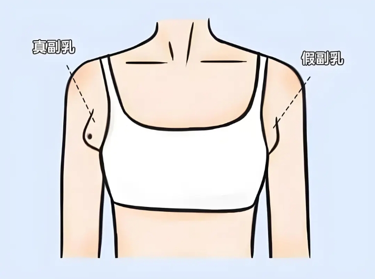 副乳怎么消除