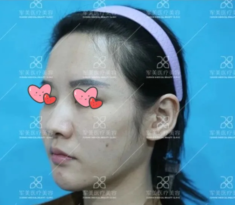大鼻头怎么缩小