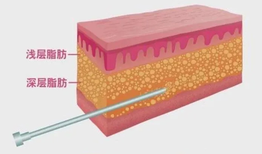 广州吸脂最好的医生