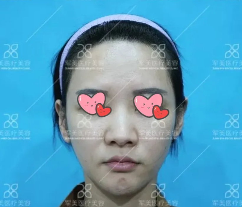 大鼻头怎么缩小