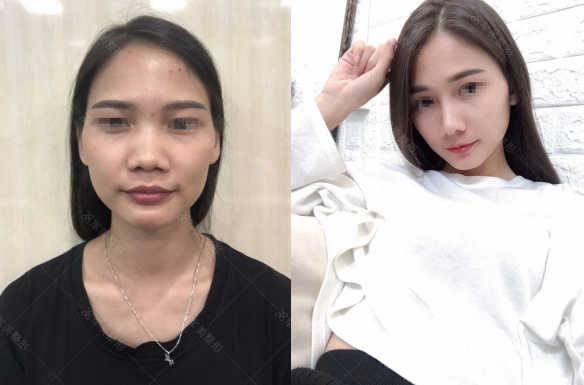 鼻基底凹陷怎么改善
