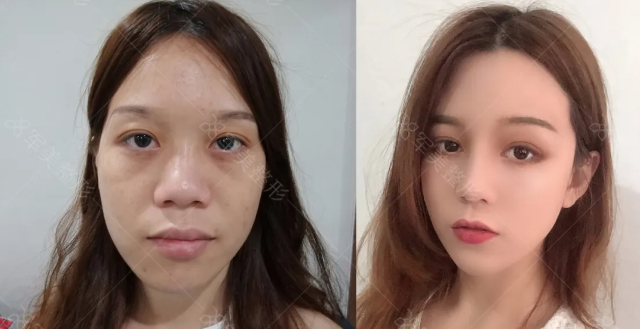 自体脂肪填充术后注意事项
