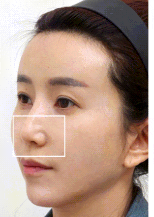 法令纹太深了怎么改善