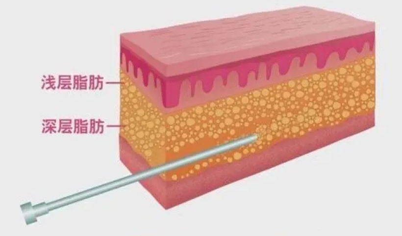 吸脂减肥案例